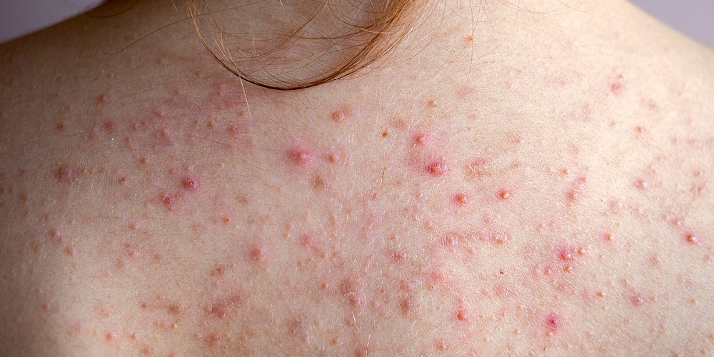 Back Acne (Bacne): Types, Symptoms, Causes & Why Vitastem Ultra is The Best Acne Treatment