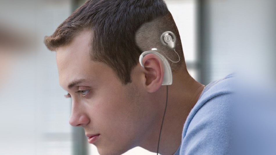 cochlear implant