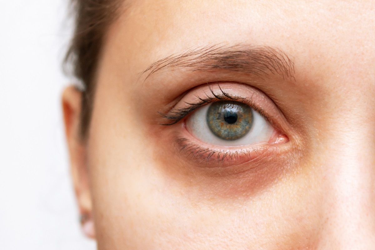 Treatment for dark circles under the eyes