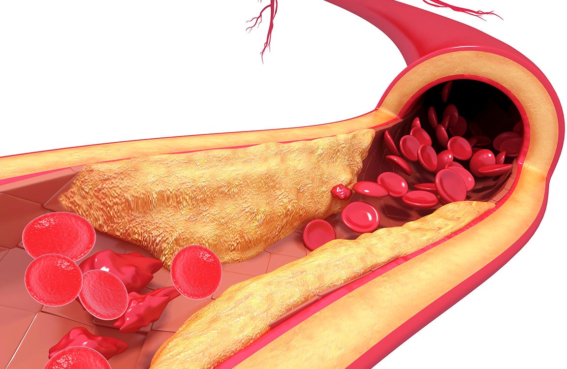 Atherosclerosis in Women: Unique Symptoms and Risks