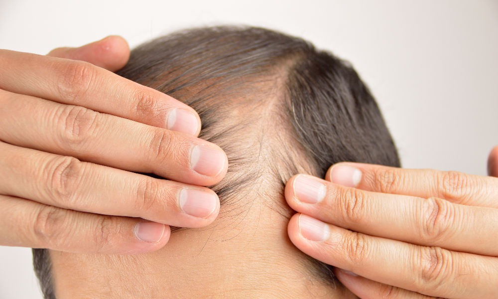 Understanding Minoxidil as a Hair Loss Treatment Pill