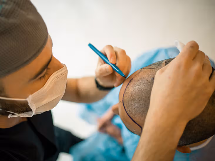 Hair Transplantation For Severe Baldness: What You Need To Know?