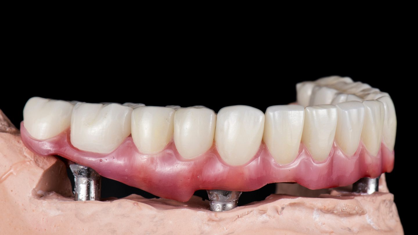 UNDERSTANDING IMPLANT‑SUPPORTED PROSTHESES